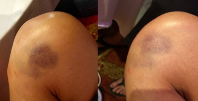 Before and after case 2
